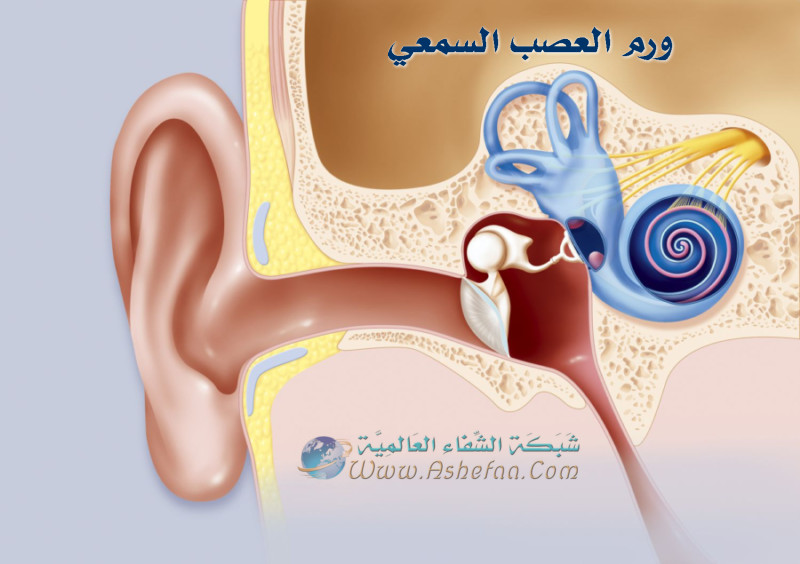 أعراض ورم العصب السمعي والعلاج