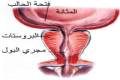 سرطان البروستاتا.. الحذر يقلل الخطر 