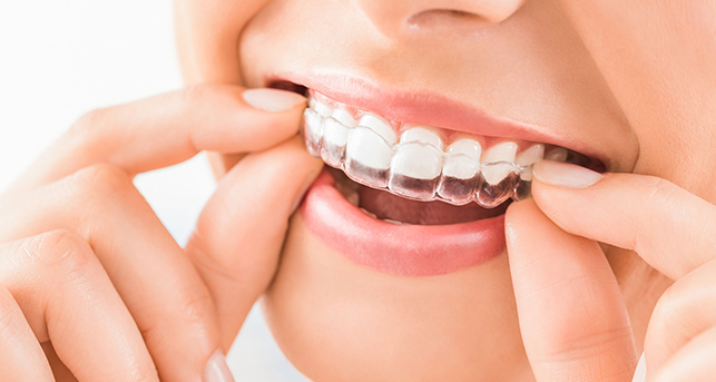 ما هو تقويم الاسنان الشفاف؟